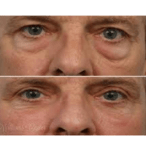 Eyelid Surgery - Blepharoplasty Nashik