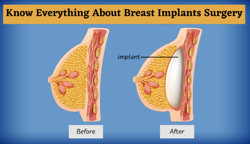 Know Everything About Breast Implants Surgery bachhavcosmeticsurgery